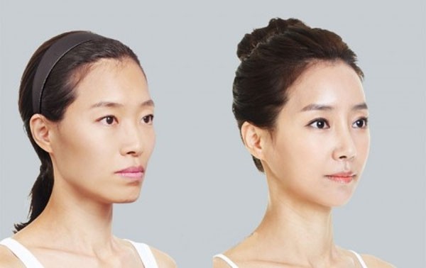 Tất tần tật những điều cần biết về cấy mỡ mặt.