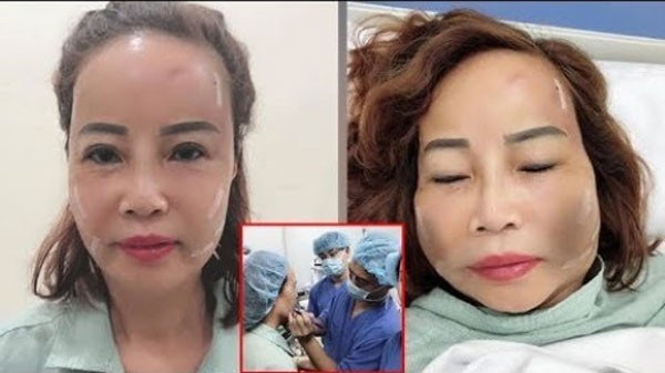 Cấy mỡ mặt có để lại biến chứng không?