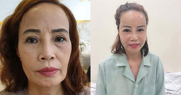Cấy mỡ mặt có những ưu điểm gì?