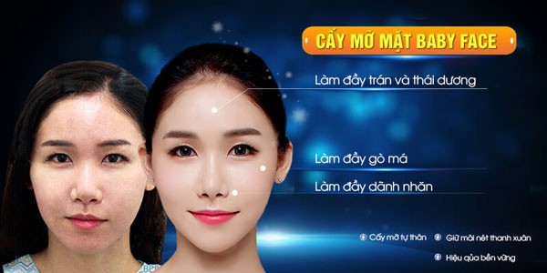 Cấy mỡ mặt có những ưu điểm gì?