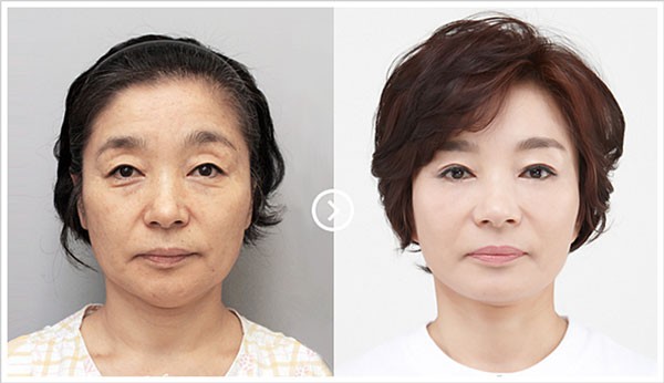 Cấy mỡ mặt duy trì được bao lâu? làm sao để có kết quả lâu dài