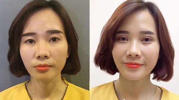 chăm sóc sau phẫu thuật cắt mí