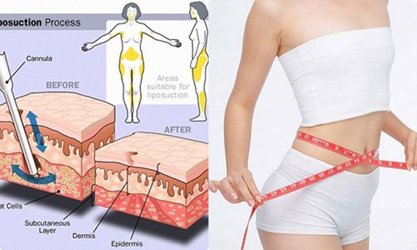 Hút mỡ bụng trên, bụng dưới, hai eo