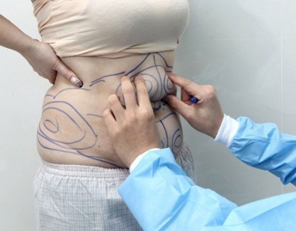 Hút mỡ bụng trên, bụng dưới, hai eo