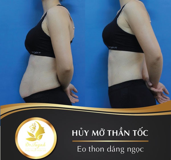 Hút mỡ bụng trên, bụng dưới, hai eo