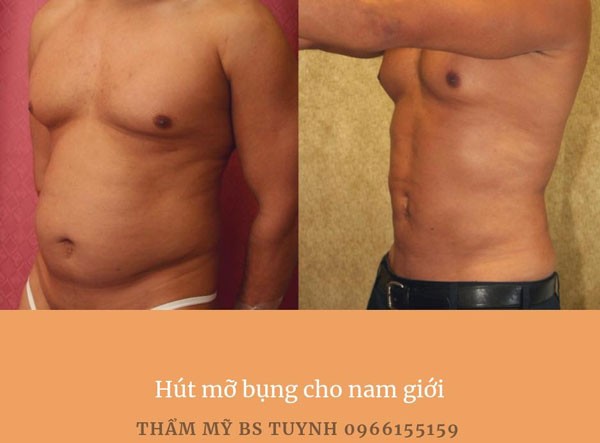 Hút mỡ bụng trên, bụng dưới, hai eo