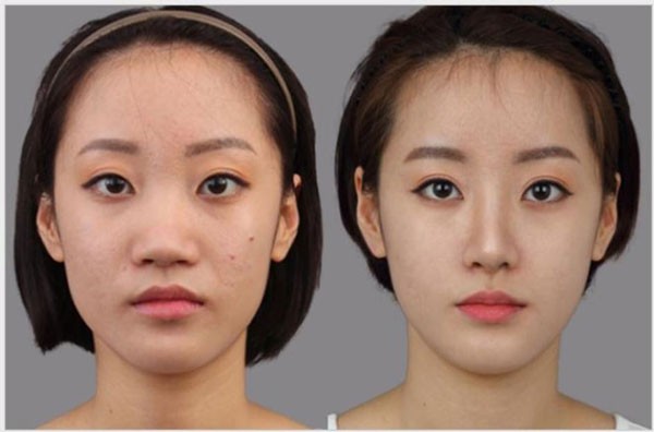 Khuôn mặt thay đổi thế nào sau khi nâng mũi