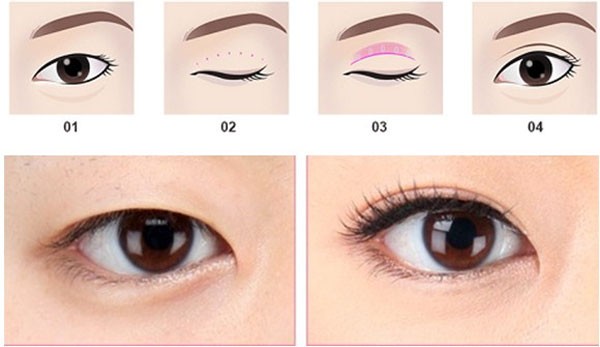 Nhấn mí bao lâu hết sưng