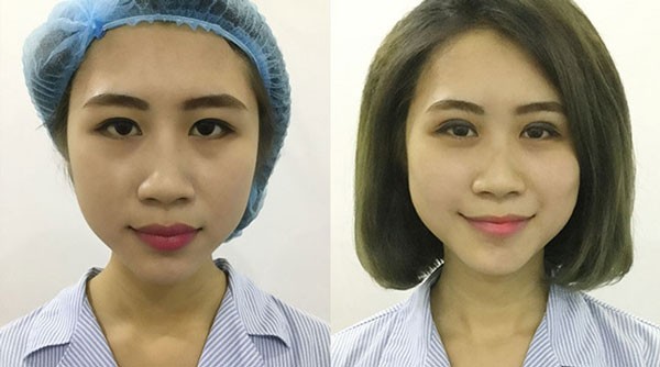Nhấn mí bao lâu hết sưng