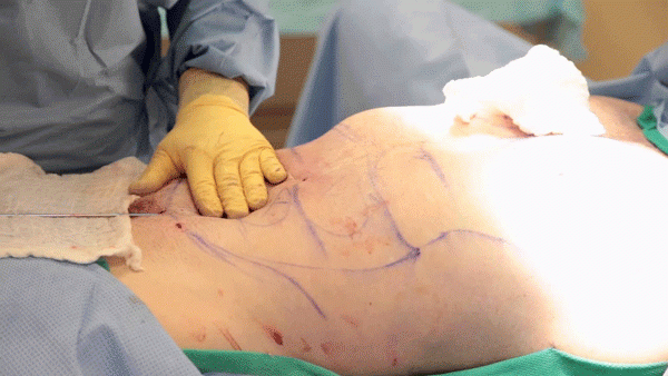 Hút mỡ: Những biến chứng có thể gặp và lời khuyên phòng tránh biến chứng