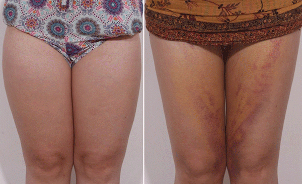 Những biến chứng có thể gặp phải sau hút mỡ