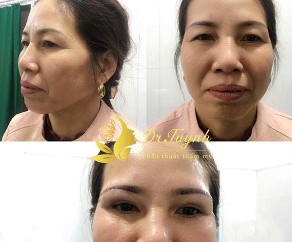 Những đối tượng nào nên áp dụng treo cung mày