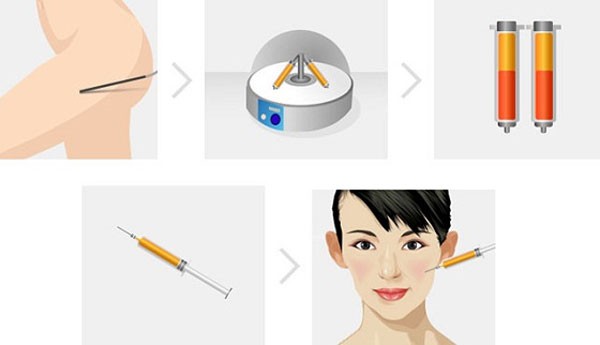 Những lưu ý khi thực hiện cấy mỡ mặt
