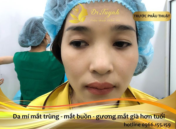 phẫu thuật cắt mí