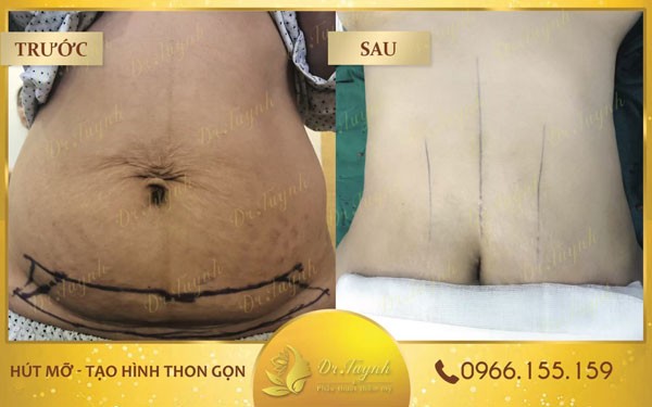 quy-trinh-thuc-hien-phau-thuat-thon-gon-bung-03