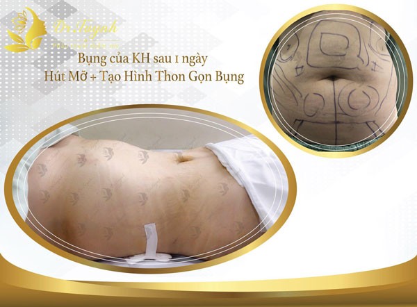Tạo hình thành bụng giá bao nhiêu?