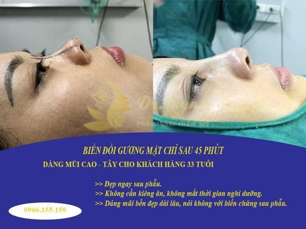 Tiêu chuẩn một chiếc mũi đẹp là mũi như thế nào?