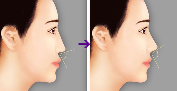 Tiêu chuẩn một chiếc mũi đẹp là mũi như thế nào?