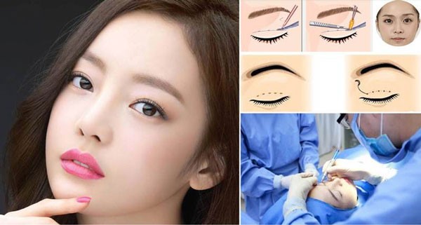 Cắt mí mắt có nguy hiểm không?