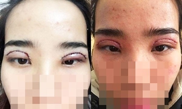 Cắt mí mắt có nguy hiểm không?