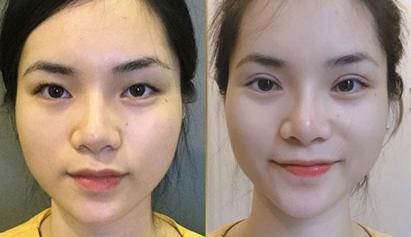 Cắt mí mắt nên hay không?