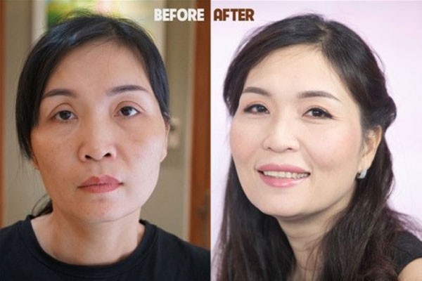 Cấy mỡ mặt ở đâu đẹp? 
