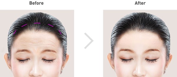 Cấy mỡ tự thân vùng mặt 