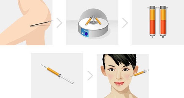 Cấy mỡ tự thân vùng mặt 