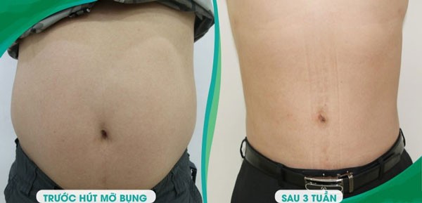 Hút mỡ bụng cho nam giới 