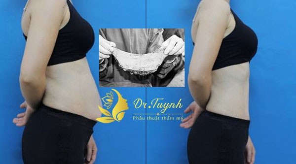 hút mỡ bụng và tạo hình thành bụng