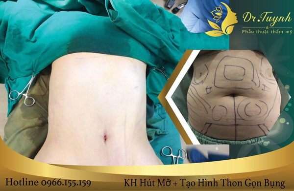 hút mỡ bụng và tạo hình thành bụng