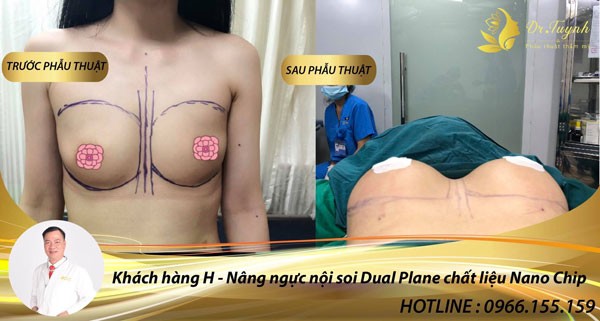 Kinh nghiệm nâng ngực nội soi