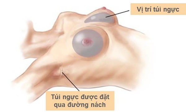 Kinh nghiệm nâng ngực nội soi