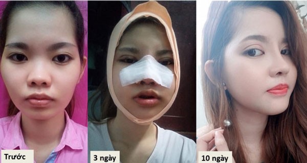 nang-mui-boc-sun-co-dau-khong-04
