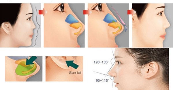 Nâng mũi bọc sụn tai giá bao nhiêu?
