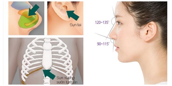 Nâng mũi bọc sụn tự thân là gì? 