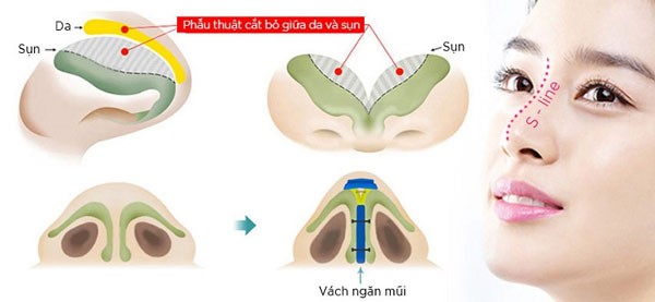 Nâng mũi bọc sụn vách ngăn S line