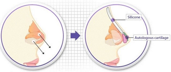 Nâng mũi bọc sụn vách ngăn S line