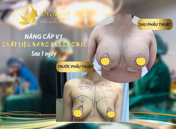 Nâng ngực chảy xệ bằng phương pháp nội soi