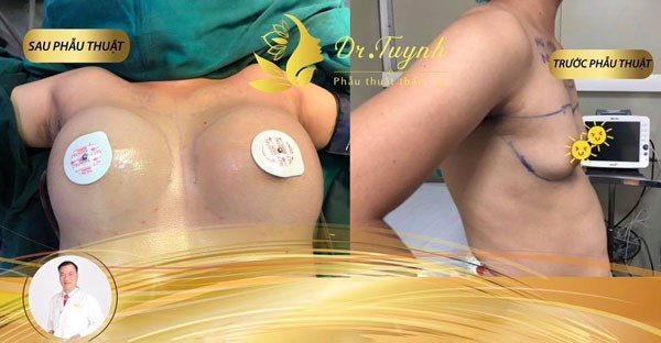 Nâng ngực chảy xệ bằng phương pháp nội soi