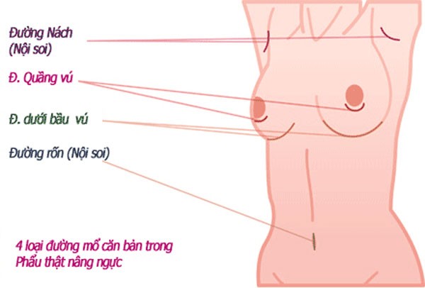 Nâng ngực nội soi đường nách