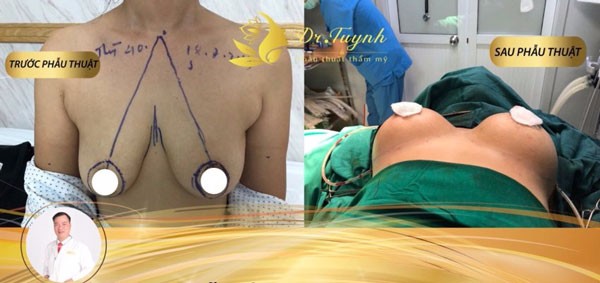 Treo ngực sa trễ không đặt túi