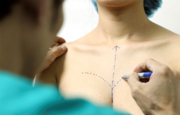 Phẫu thuật nâng ngực nội soi có đau không?