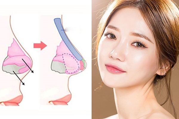 Phương pháp nâng mũi bọc sụn