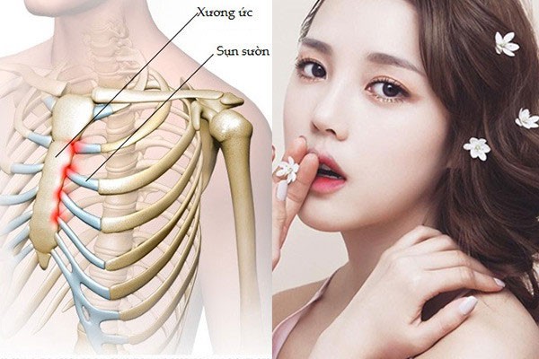 Phương pháp nâng mũi bọc sụn