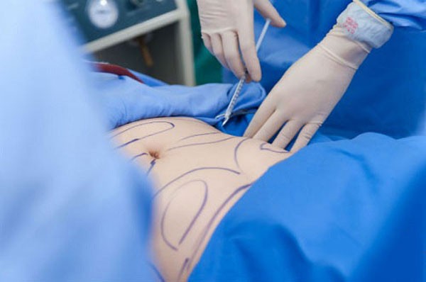 Giá tiền hút mỡ bụng 