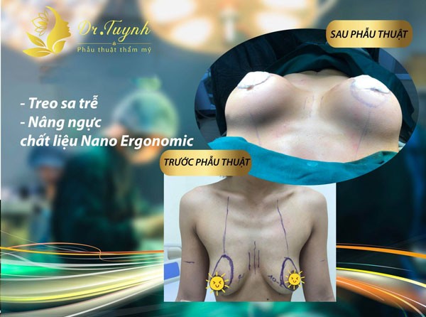 Treo ngực sa trễ có ảnh hưởng gì không? 