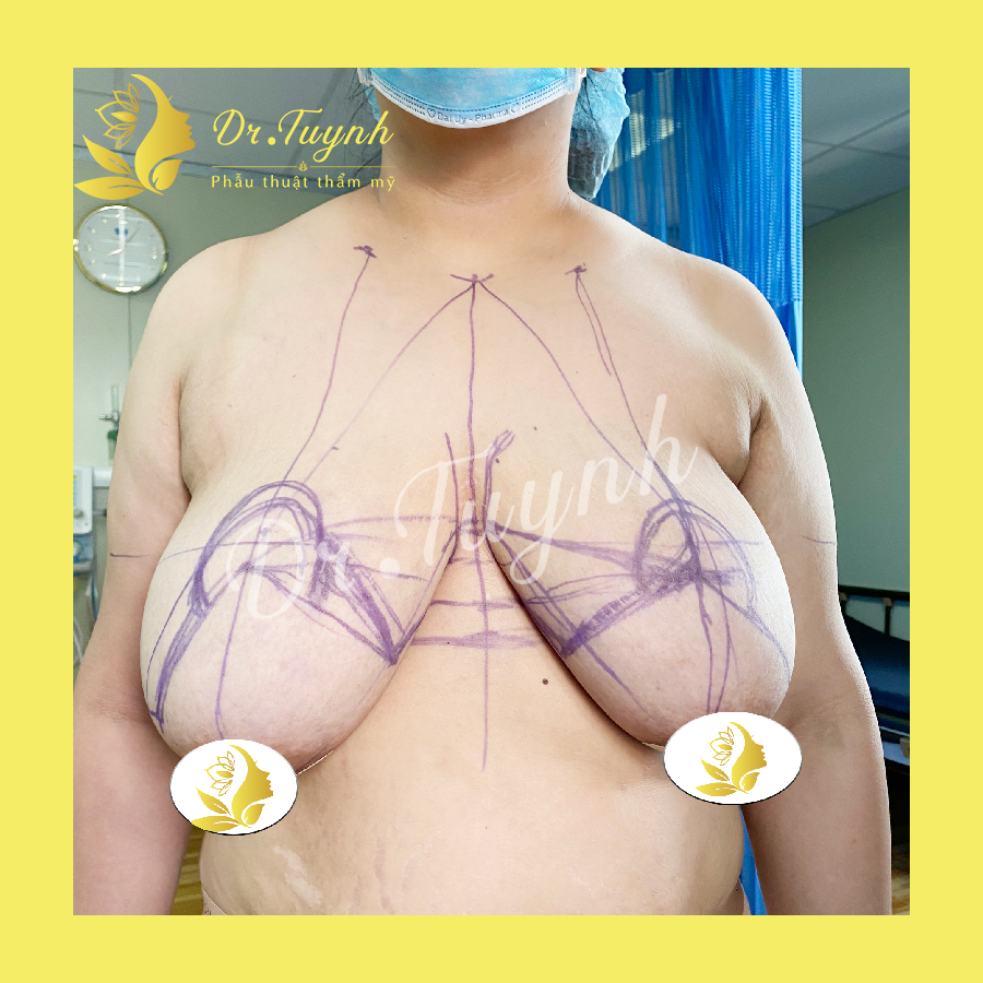 Ngực phì đại: Không còn là gánh nặng!