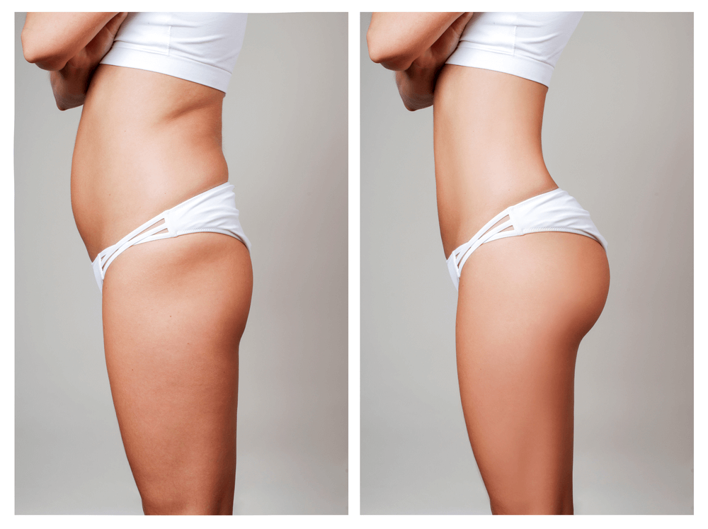 Hút mỡ vòng 2 - tăng size vòng 3: Dr.Tuynh Làm 1 bạn sẽ được lợi 2