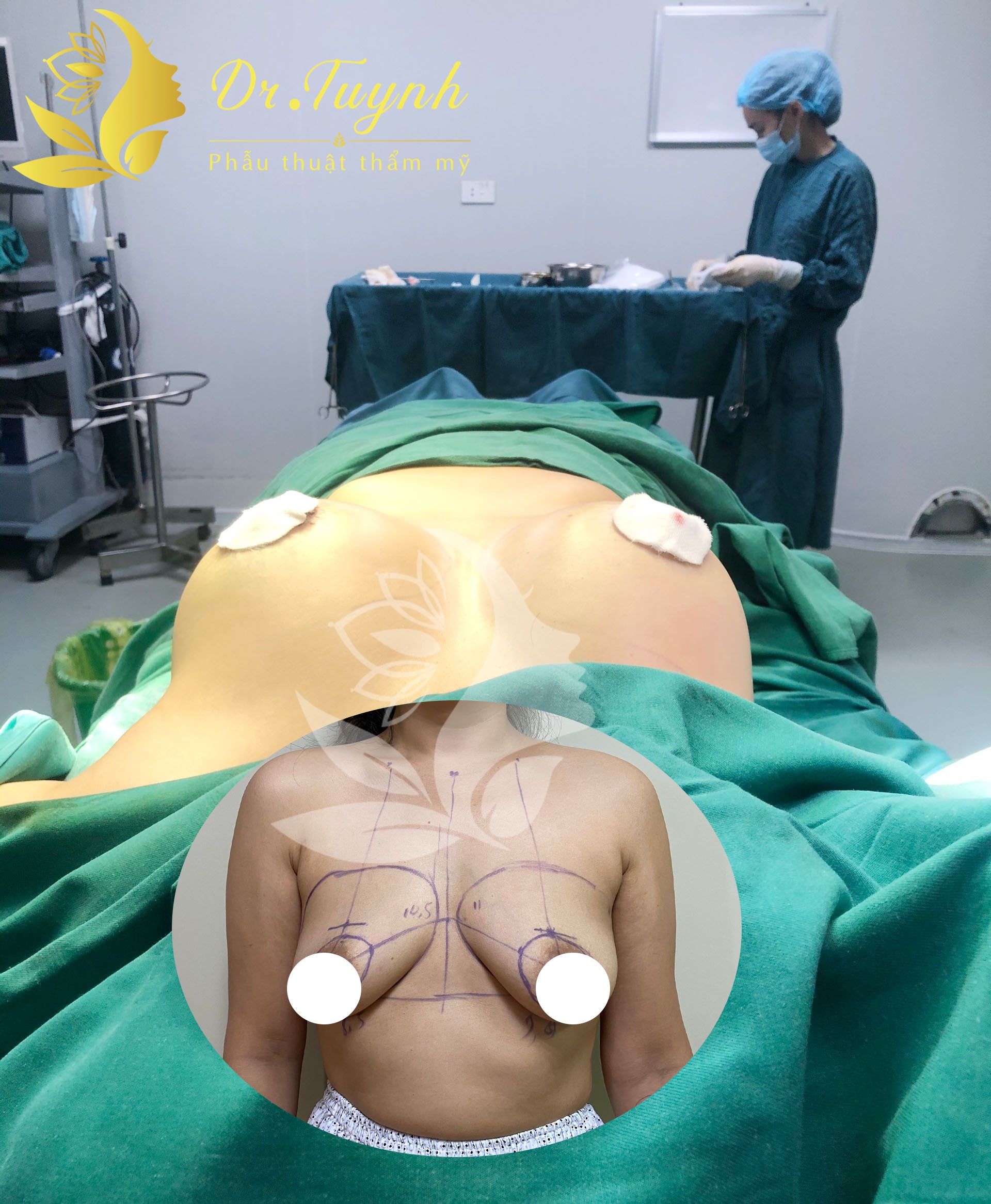 NÂNG NGỰC SA TRỄ BẰNG KỸ THUẬT ĐẶT TÚI ĐỘN NGỰC SILICONE GEL